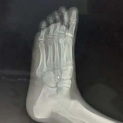 全脚掌走路哪几根跖骨负重?