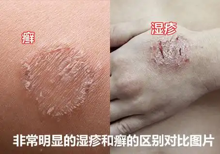 湿疹和癣的区别图片区分图对比