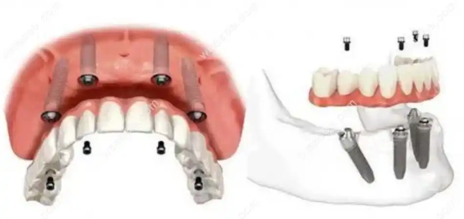 半口种植牙示意图
