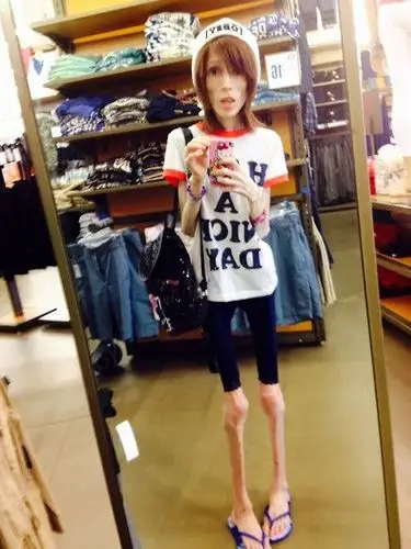 女子为摆脱"婴儿肥"患厌食症:骨瘦如柴似骷髅(图)