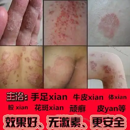 神农癣大夫牛皮乳膏体股藓大腿内侧足脚丫气皮肤痒止痒软膏癣药