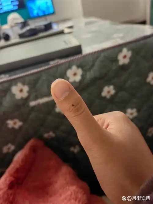 提问:右手大拇指长痣代表什么?