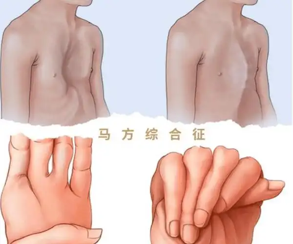 约为1/5000~1/3000马凡氏综合征的发病率具有家族集聚性与遗传因素