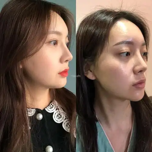 轮廓手术后半年,居然可以这么美_韩国整形日记_韩国整容前后对比照片