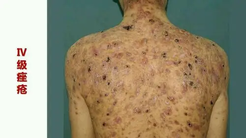 皮肤痤疮国际改良分级法