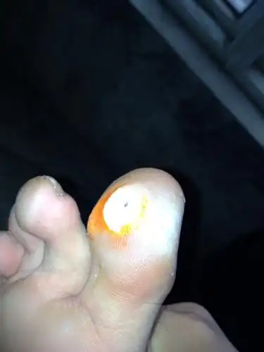 鸡眼挖成这样 是不是他长好就可以了. 挖到最低 下?亲门.