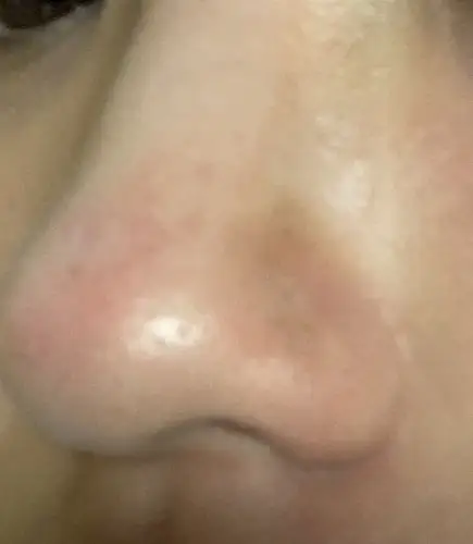 为什么我的鼻翼突然黑了一坨