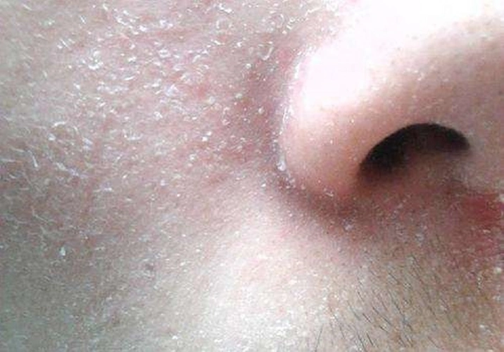 肌肤敏感又干燥,如何补水呢?有6种方法,或能让肌肤充盈水分_皮肤