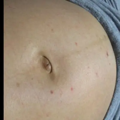 宝妈们肚子会长这些吗?起个红点,有点痒,我就去就会去挠,是不是过敏?