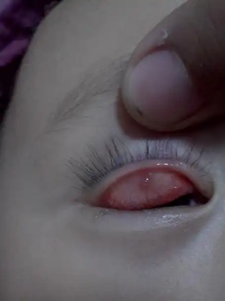 主要症状等): 几个月前眼睛上眼睑外侧起了一个硬疙瘩,但不是浮在眼皮