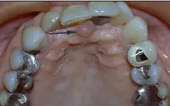 切牙乳突是排列上中切牙的解剖标志,是因为().