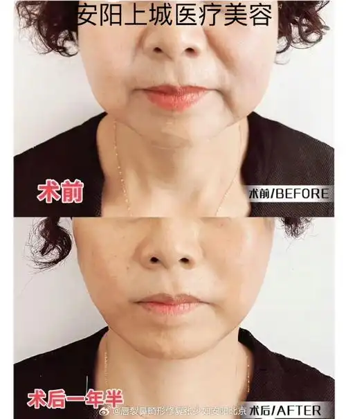 拉皮术后一年半反馈 主要是改善中下面部的松弛下垂情况,口角囊袋