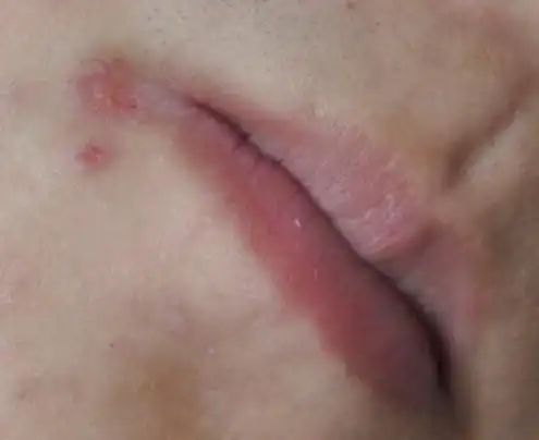 嘴角溃烂,多吃蔬菜也不见好,是缺什么?或者说是上火么?