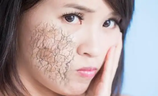 皮肤缺水的表现你中招了吗 给皮肤正确补水还你水光肌