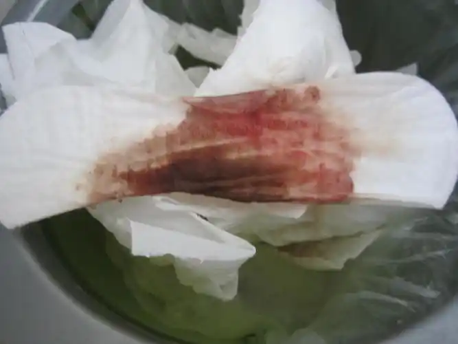 刚刚我发现卫生巾上有血看起来像月经有图片麻烦医生帮我看