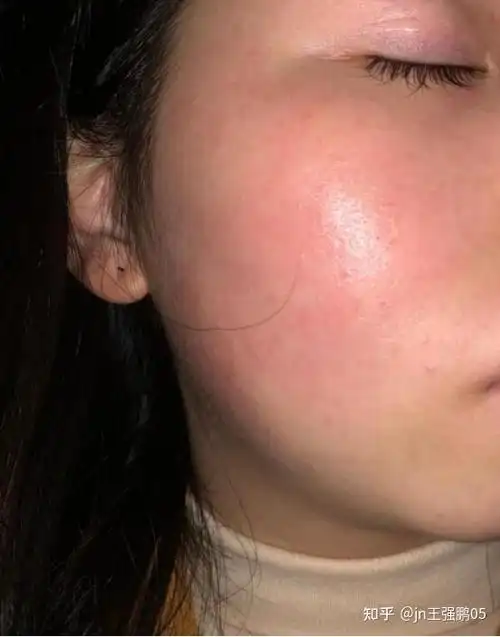 角质层薄日常如何修复角质层薄该怎么护肤