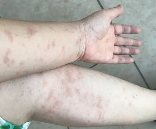 药物过敏全身性皮疹