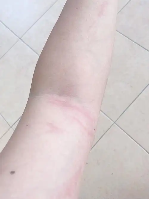 胳膊上长湿疹太痒了