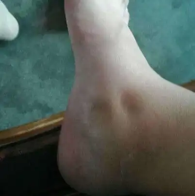 肾脏接近"报废"的男人,脚上"3迹象"很明显,久拖变成尿毒症