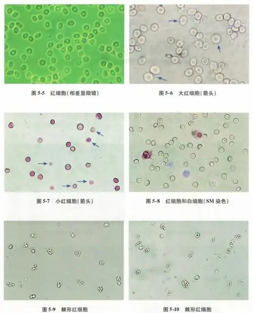 一文读懂尿液红细胞形态分析