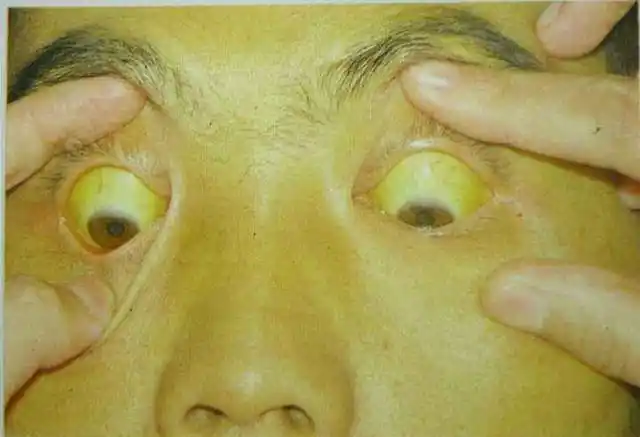 2,黄疸简单说就是面色发黑,没有光泽,晦暗,皮肤粗糙干燥,没有弹性等等