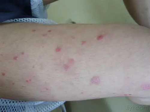 急性点滴型银屑病