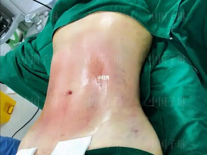 吸脂_减肥_高山街不夜城自由行热门攻略_高山_雕刻_腰腹_减肥经验分享