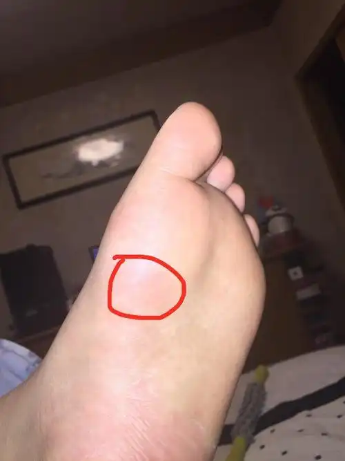 大脚拇指往上翘以及 走路蹬地的时候前脚掌有一个点特别疼 只要碰到就