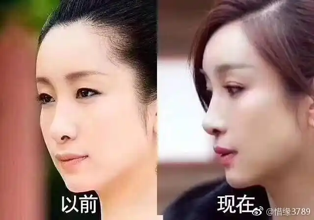 为单眼皮买保险的秦海璐,如今也割双眼皮,背后原因万万没想到!