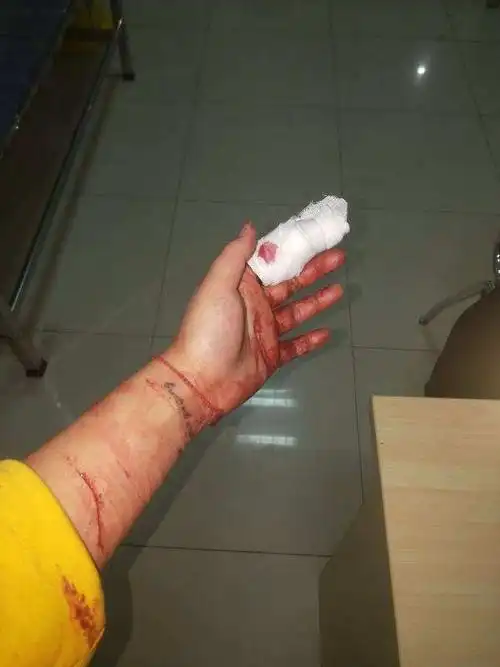 手腕割伤高清图片,割手腕伤口真实图片-图片大观-奇异网