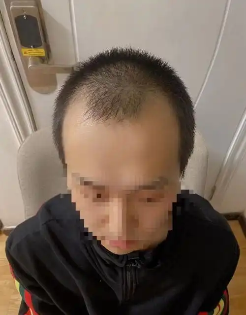 m型发际线是脱发的开端,如果不及时介入治疗,前额两侧的头发就会开始