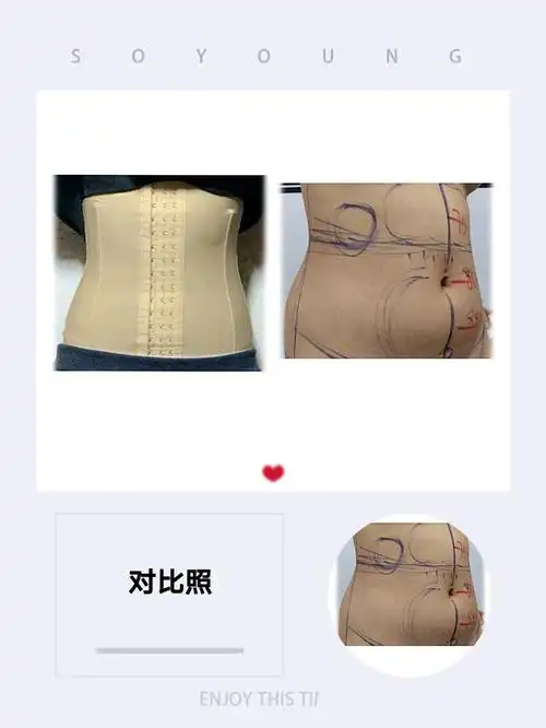 腰腹环吸抽脂第8天反馈来啦!