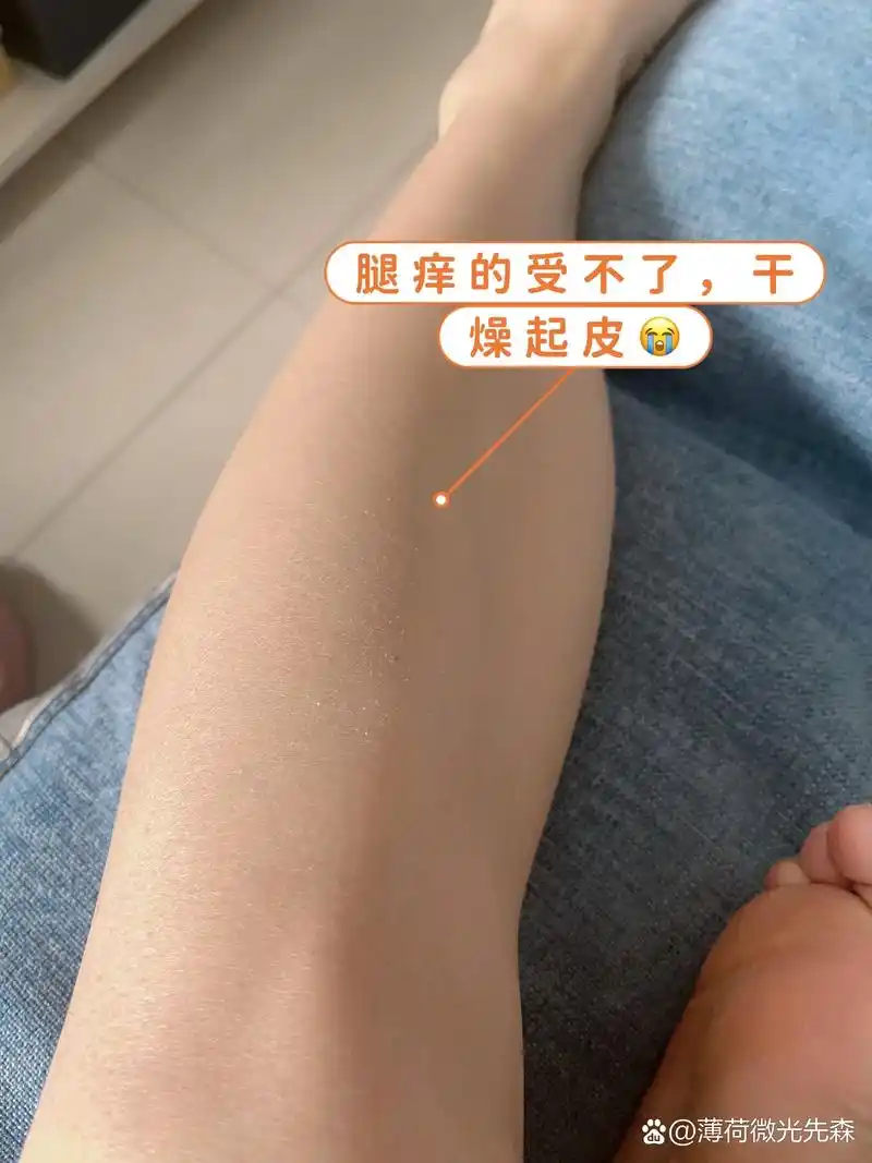 冬天小腿痒,干燥脱皮,痒的睡不着觉的看过来