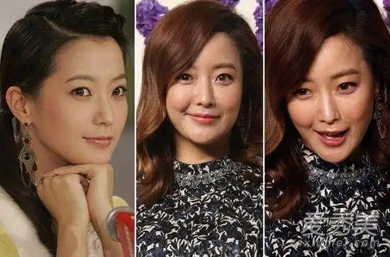 韩星金喜善整容后遗症:眼歪嘴斜见不得人(图)