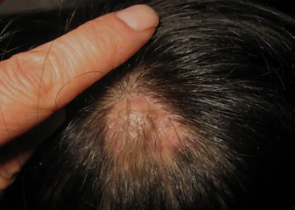 头皮毛囊炎好几年了,一直反反复复,最近头发少了一撮,心里好慌