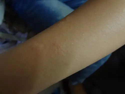 我的手臂上长了多小红疙瘩