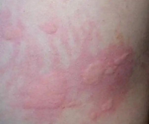 寒冷性荨麻疹手背皮肤病图片