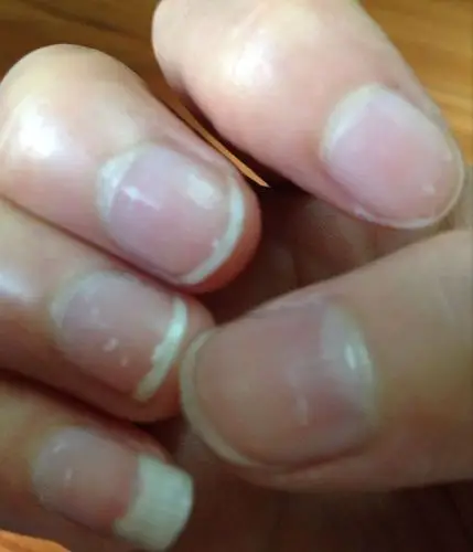 指甲上面那个小白点是什么呢?会不会有什么问题?求解,谢谢