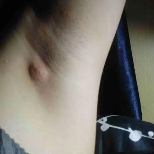 腋下长了个包,硬,疼.