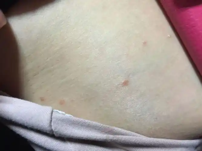 最近,我胸部两旁长出了一些红色像痘痘一样的东西