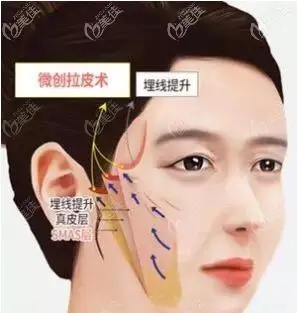 风筝小切口拉皮为什么维持时间更久一些