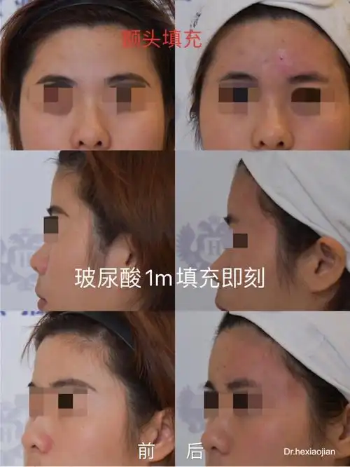 好看的额头千篇一律你喜欢哪种