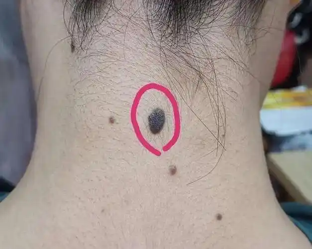 是大富大贵的象征,长痣的位置越靠近脖子正中一样,就是所谓的靠山痣