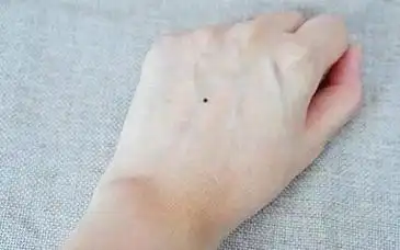 女人右手背有5颗痣图解女人手背都有什么含义