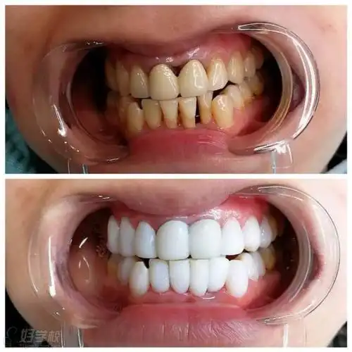 9d美白牙全瓷贴面培训