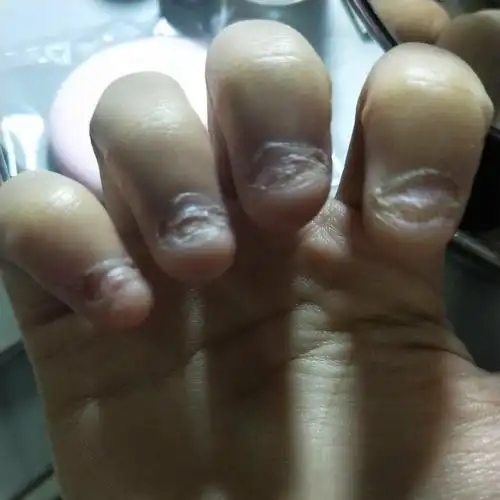 11.6更新‖慎入 本组最差指甲 啃了二十年的指甲,应该已经.