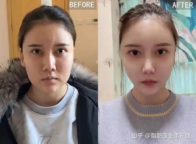 为什么做完面部脂肪填充会出现假面,大小脸,寿星公额头?