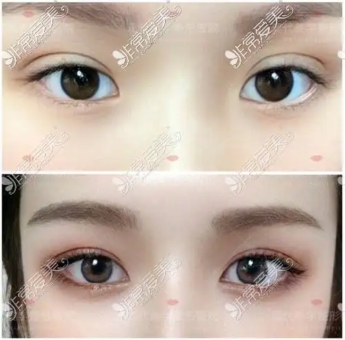 韩国双眼皮修复宽改窄的效果也太好了吧去韩国做眼睛修复就选这家