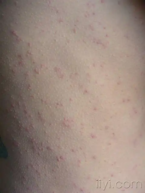 过敏性皮炎?湿疹?