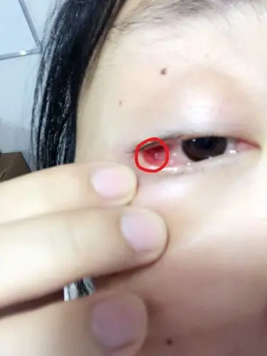 眼角内测长了个绿豆大小的包,眨眼按压都会疼,是麦粒肿吗?